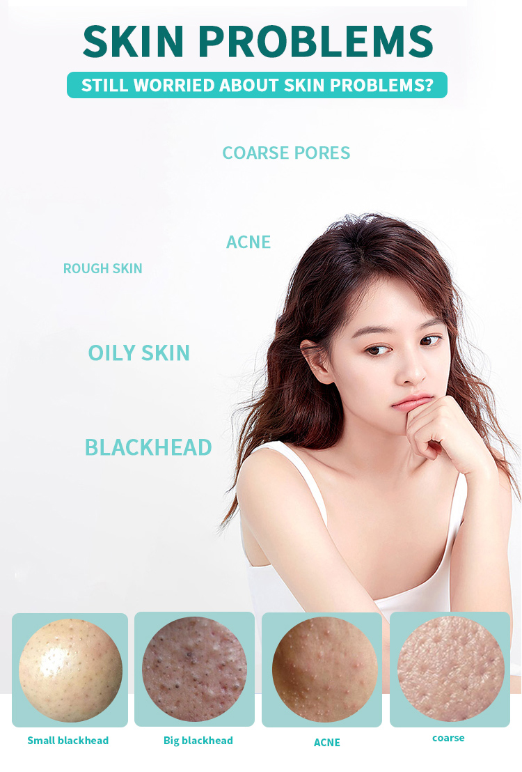 microdermabrasion for acne