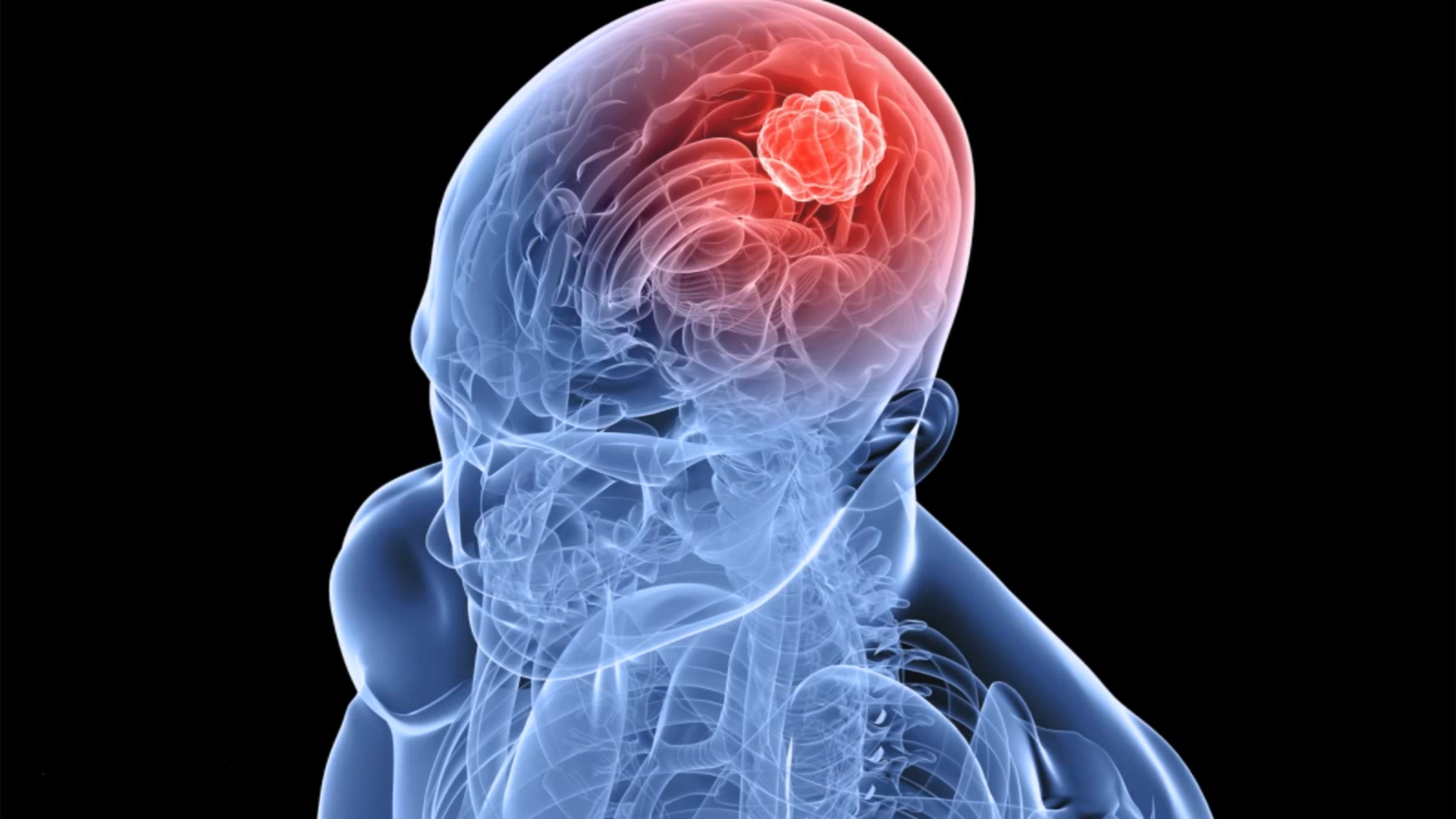 زيت القنب يتقلص ورم الدماغ - RSO خالٍ من السرطان -2