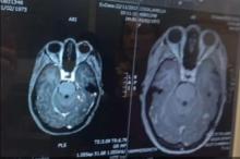 The Story of Cannabis Curing Brain Cancer - RSO Cancer Free